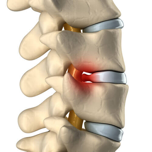 Tips for relieving pain from herniated discs