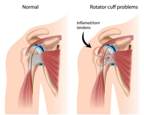Is Your Shoulder Pain Coming From The Rotator Cuff? -Innovative PT